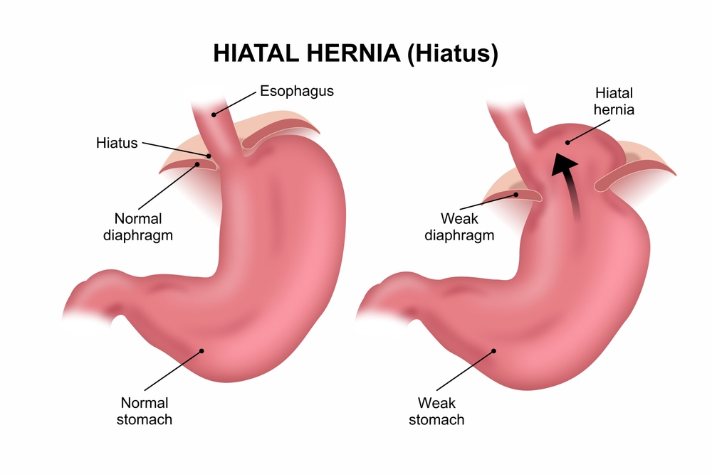 Hiatal hernia (hiatus) 3D illustration